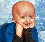 Czteroletni chłopiec cierpiący  na progerię. Choroba objawia się przedwczesną starością