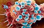 Tak wygląda komórka raka piersi widziana w mikroskopie elektronowym