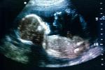 W siódmym miesiącu ciąży płeć dziecka można już doskonale rozpoznać. Takie zdjęcie może być przepustką do życia  lub wyrokiem 