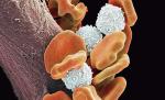Komórki człowieka chorego  na białaczkę widziane pod mikroskopem
