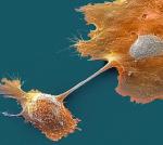 Skuteczne leczenie nowotworów trzustki (komórka na zdjęciu) jest priorytetem onkologów 