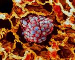Komórki raka płuc pod mikroskopem. To najczęstszy typ nowotworu na świecie. Zabija ponad 1,5 mln osób rocznie