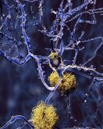 Gromadzenie się amyloidów w mózgu jest, jak uważa wielu ekspertów, przyczyną choroby Alzheimera