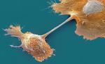 Komórki raka trzustki. Nieregularny, postrzępiony kształt charakterystyczny jest dla komórek nowotworowych
