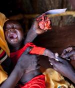 Największą grupę ofiar malarii stanowią dzieci do piątego roku życia