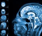 Dzięki obrazowaniu fMRI odkrywa się wiele przypadków osób, u których brakuje niemal całej tkanki mózgowej.