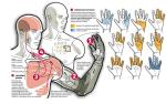 Proteza wraŻliwa na dotyk. Naukowcy wyłuskali ocalone nerwy ręki z kikuta i skierowali je do klatki piersiowej. Dzięki temu wiele miejsc na piersi zostało unerwionych na nowo. Idea polega na tym, by protezę wyposażyć w sensory, które będą rejestrować nacisk i wysyłać impulsy do odpowiednich punktów na klatce piersiowej pacjenta. Podrażnione nerwy prześlą sygnały dalej, do mózgu.