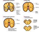 Różnica między mózgiem zdrowym a dotkniętym neurodegeneracją