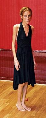 Francuska aktorka Isabelle Caro cierpi na anoreksję od 13. roku życia. Bohaterka kampanii społecznej ze zdjęciami Toscaniego