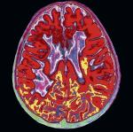 W mózgu chorego na SM dochodzi do degradacji dużych fragmentów tkanki, co widać na zdjęciu wykonanym za pomocą rezonansu magnetycznego  