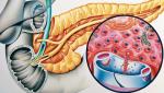 Cukrzyca typu 1 wiąże się z niszczeniem komórek beta trzustki (w kolorze czerwonym, żółta trzustka) produkujących insulinę
