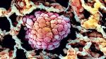 Komórki raka płuc widoczne okiem elektronowego mikroskopu skaningowego (SEM)